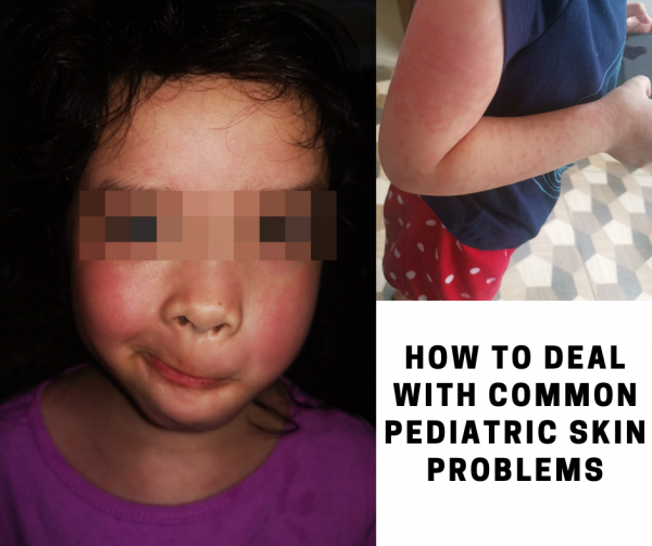 How to Deal with Common Pediatric Skin Problems | Pinay ...